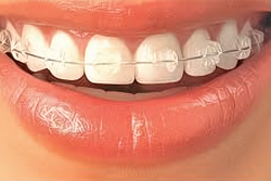 fotka 25 ortodoncija